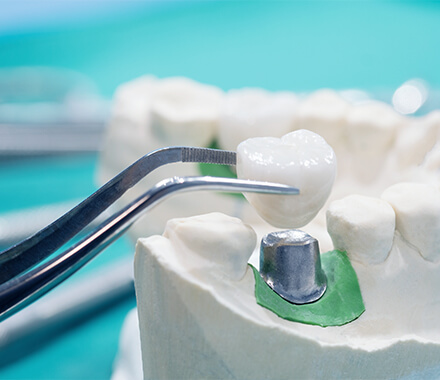 M.D.S. PROSTHODONTICS AND CROWN & BRIDGE